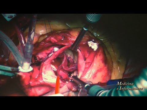 Tecnica Ozaki per la sostituzione della valvola aortica con pericardio del paziente