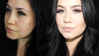 How I Conceal My Dark Spots & Acne Scars