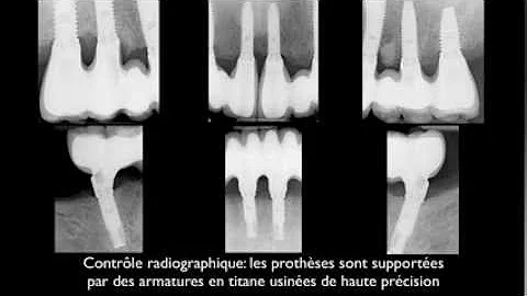 Est-il possible de remplacer toutes ses dents