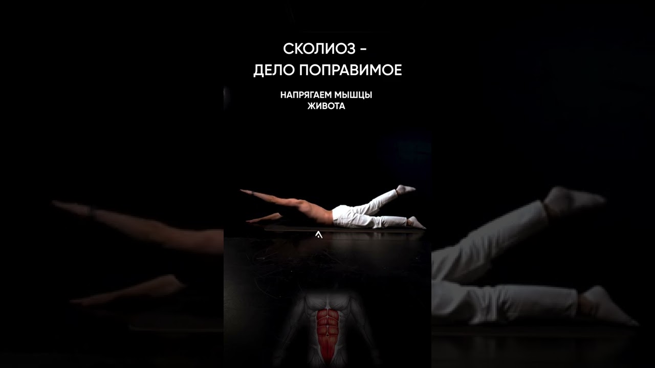 Сколиоз - дело поправимое. #сколиоз #сколиозбезоперации #реабилитация #спина #болитспина