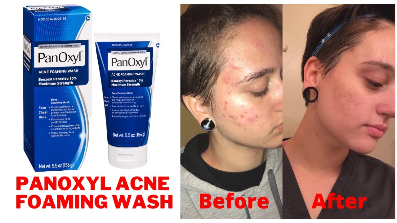 Acne Wash Before Or After Shaving at Dwight Martin blog