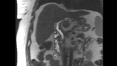 Intrahepatic cholangiocarcinoma