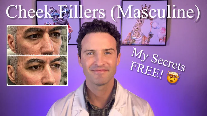 Cheek Fillers (Masculine face) My technique