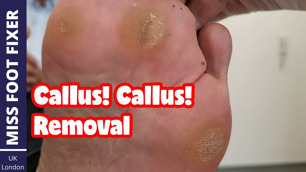 Callus Callus Callus On Foot | Thick Callus Removal From Foot Full ...
