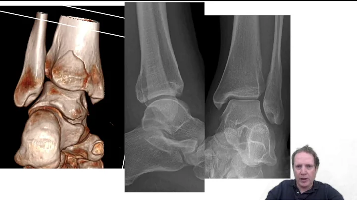 Case Takeaway - Maisonneuve Ankle Fracture And Medial Deltoid Ligament Injury - Lyndon Mason