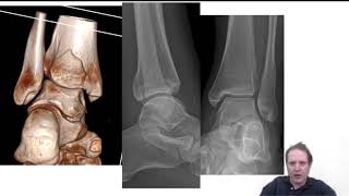 case takeaway - maisonneuve ankle fracture and medial deltoid ligament injury - Lyndon Mason