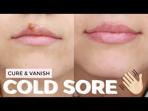 Video: Scab On Lip: Cauze, Tratament și Recuperare