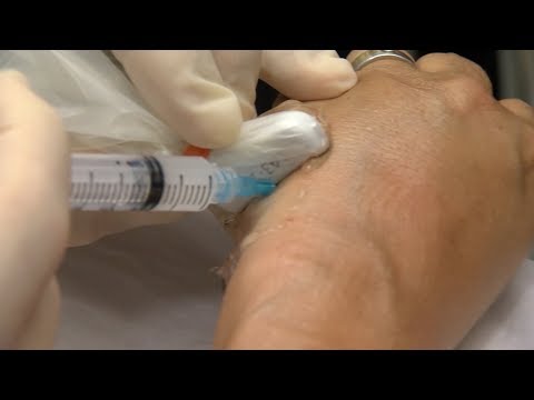 Video: Injectarea de cortizon doare?
