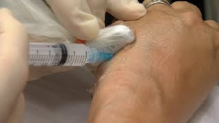 Mayo Clinic Minute: Benefits and risks of corticosteroid shots screenshot 5