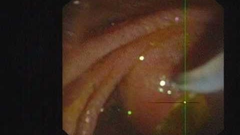 ERCP papillotomy and stone extraction 25.01.12.wmv