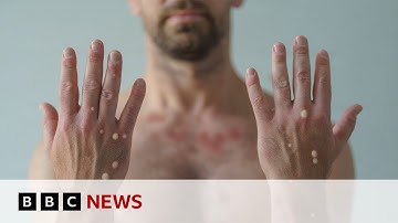First case of more spreadable mpox detected in UK | BBC News