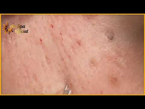 Excellent job cleaning the face