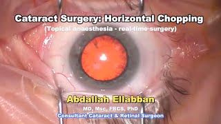 Cataract Removal in Real-Time: Horizontal Chopping Technique, using only numbing drops.