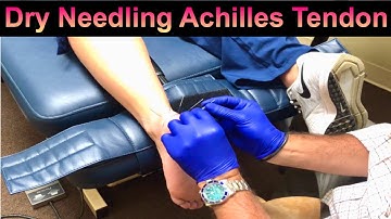 Dry Needling Achilles Tendinitis and Foot Pain