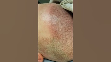 Scalp Micropigmentation Up Close