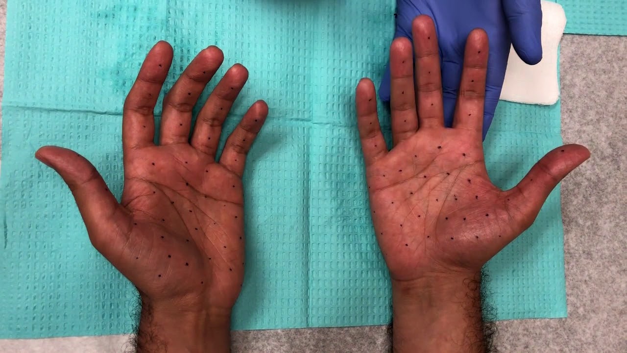 Carpe Antiperspirant Hand Lotion - Hyperhidrosis Network