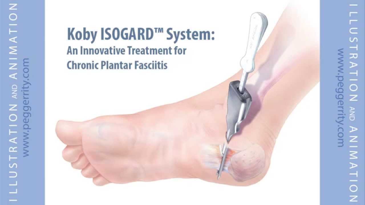 Plantar Fasciitis Surgical Treatment Animation by