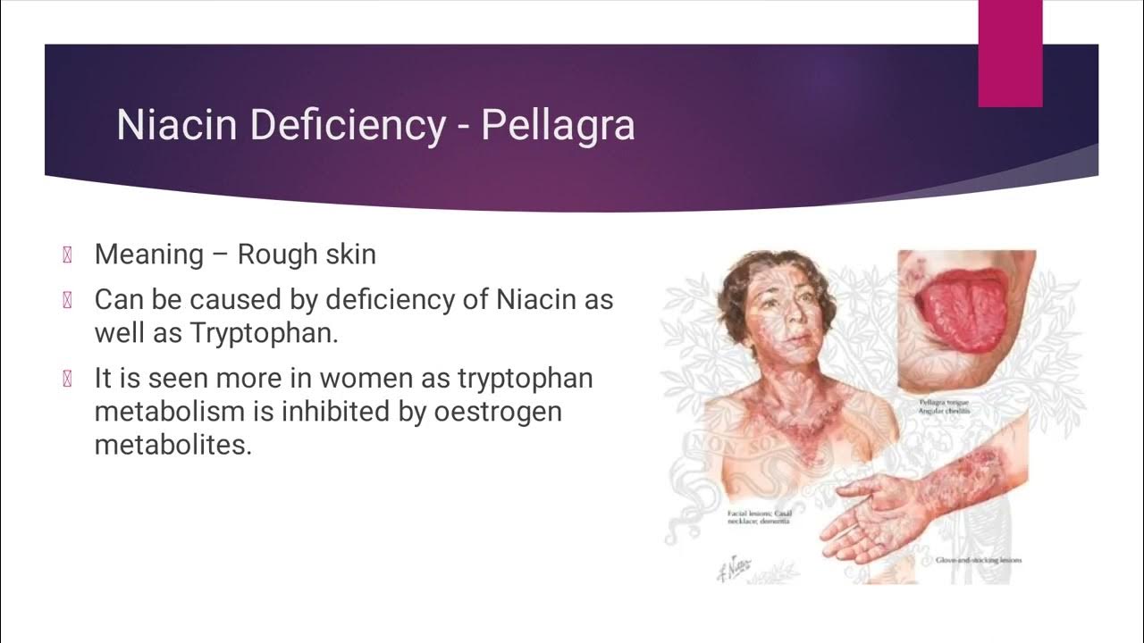 Niacin, Pellagra YouTube
