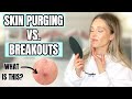 SKIN PURGING VS BREAKOUTS | HOW TO TELL THE DIFFERENCE