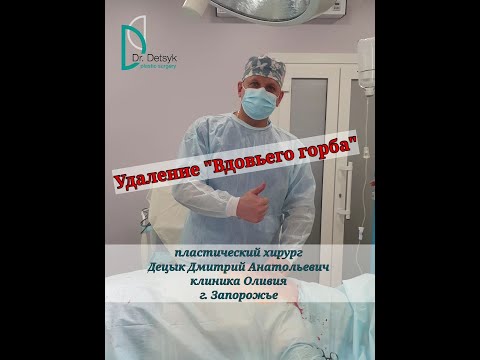 Удаление "Вдовьего горба" - липосакция горба.