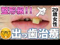 【29歳女性】整形級出っ歯治療🦷  [29 year old female] Plastic surgery-grade bucktooth treatment 🦷