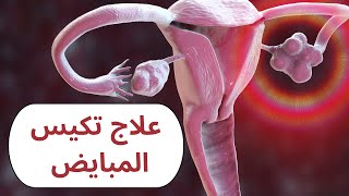 علاج تكيس المبايض