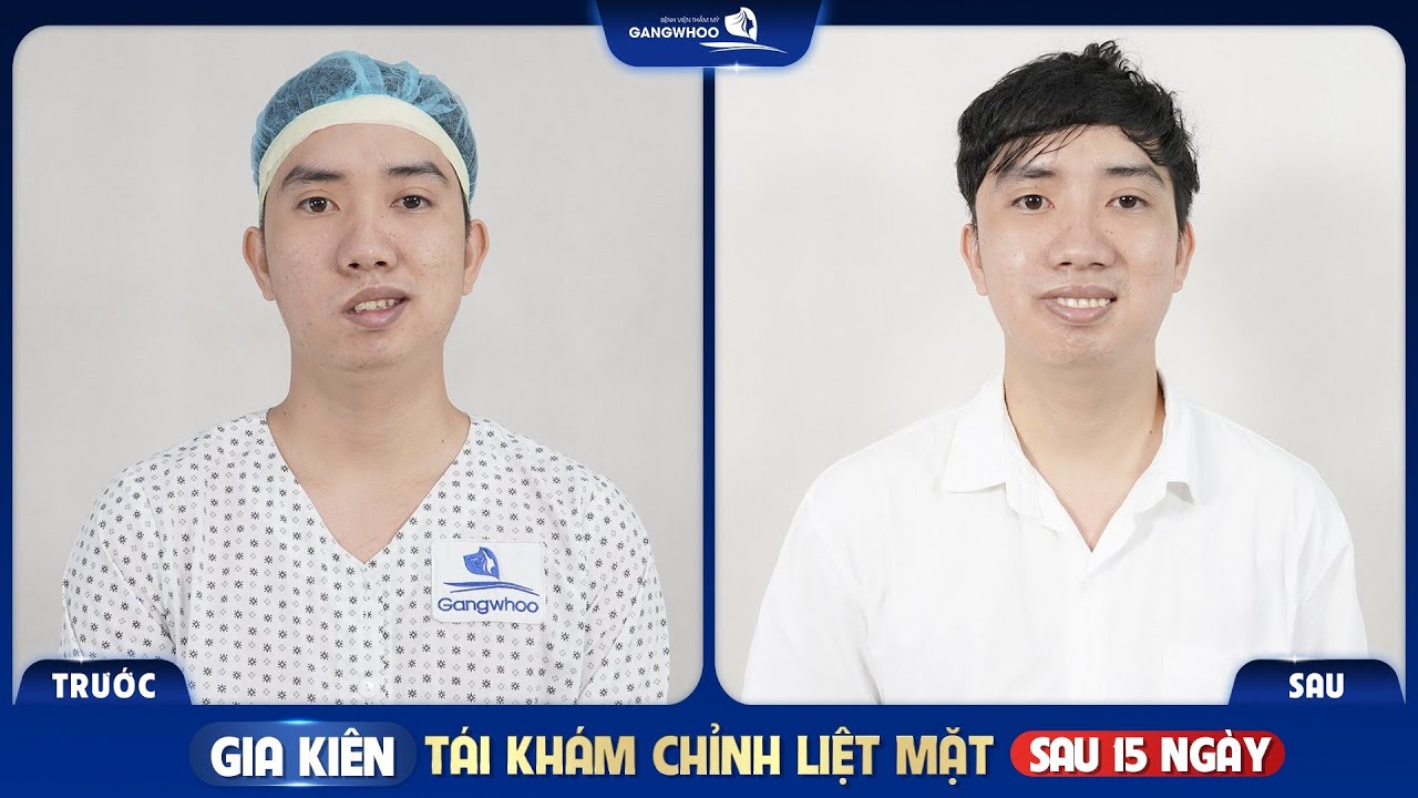 HẠNH PHÚC SAU KHI CHỮA LIỆT DÂY THẦN KINH SỐ 7 NGOẠI BIÊN LÂU NĂM | ĐIỀU TRỊ LIỆT MẶT TẠI TPHCM