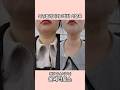 깊었던 목주름이 옅어지는 과정! 청담 #울쎄라토스 로 가로목주름 없애기!
