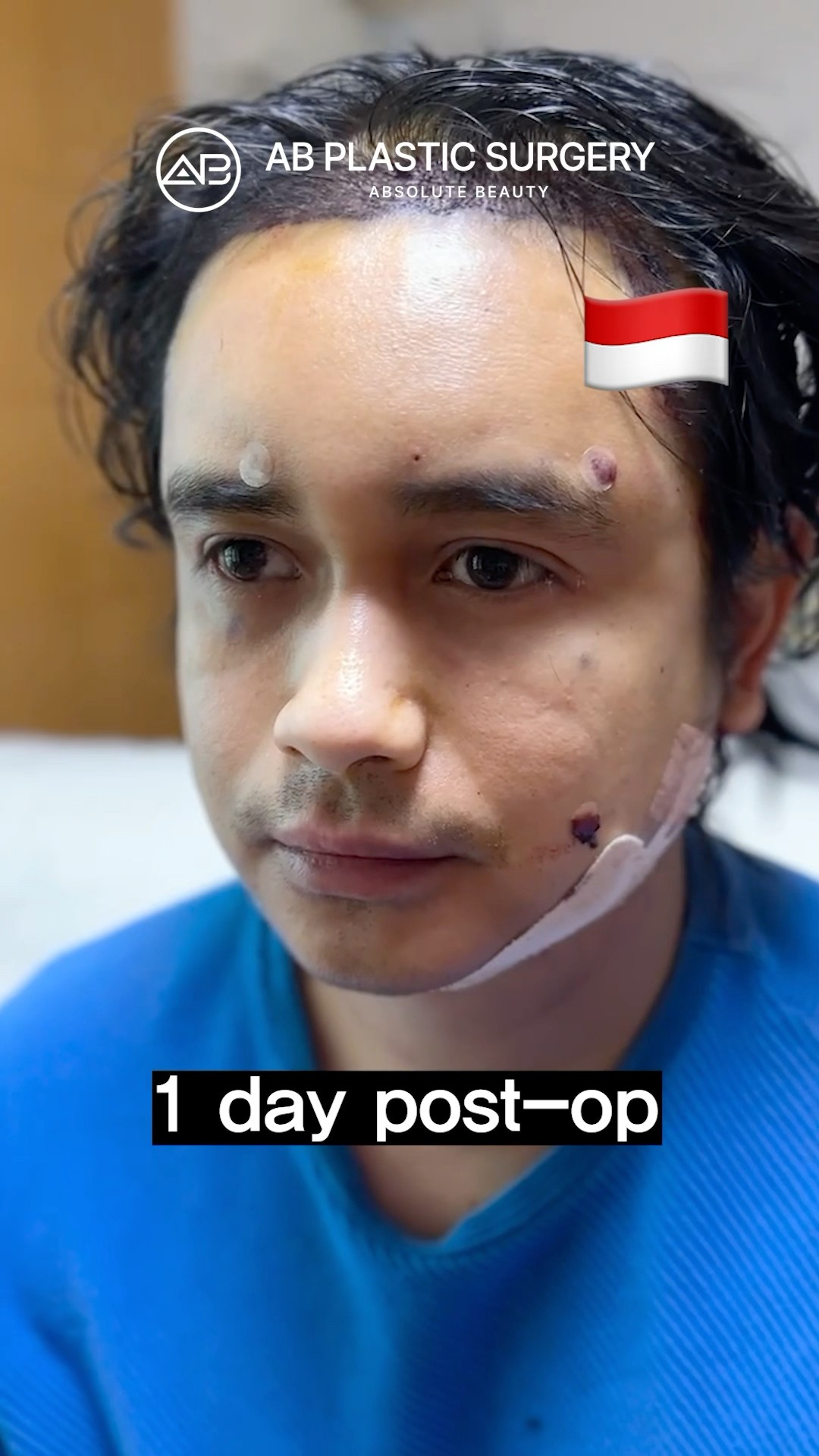 This Is After Double Chin Surgery #koreanplasticsurgery