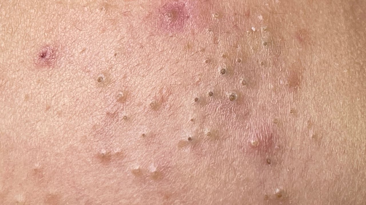Effective skin care and Happy life with blackheads #270 P2 (Linh My Dang) Cute baby