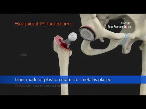 Revision Hip Replacement