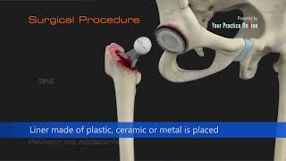 Revision Hip Replacement