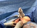 Capsular Contracture FIX!!! / Live Breast surgery