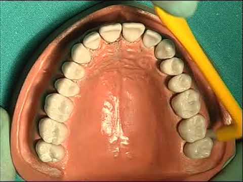 MONOCIUFFO PARODONTO SPESSO - Manuale Online Per Igienista Dentale