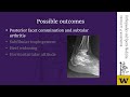 Intra articular Calcaneus Fractures  Updates on Management