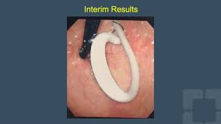 Uromonitor Catheter-Free Wireless Ambulatory Cystometry Is Feasible, Safe, And Well-Tolerated