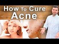 How to Cure Acne Naturally – Best Diet, Supplements and Vitamins