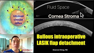 Intraoperative LASIK flap bullous detachment during intraocular lens exchange.  Shannon Wong, MD.
