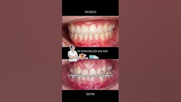 Hàm răng niềng xong có thể bị yếu đi nếu chúng ta không bảo vệ đúng cách