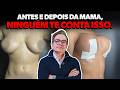 7 Perguntas Sobre Cirurgia de Mama Que Ninguém Tem Coragem de Fazer