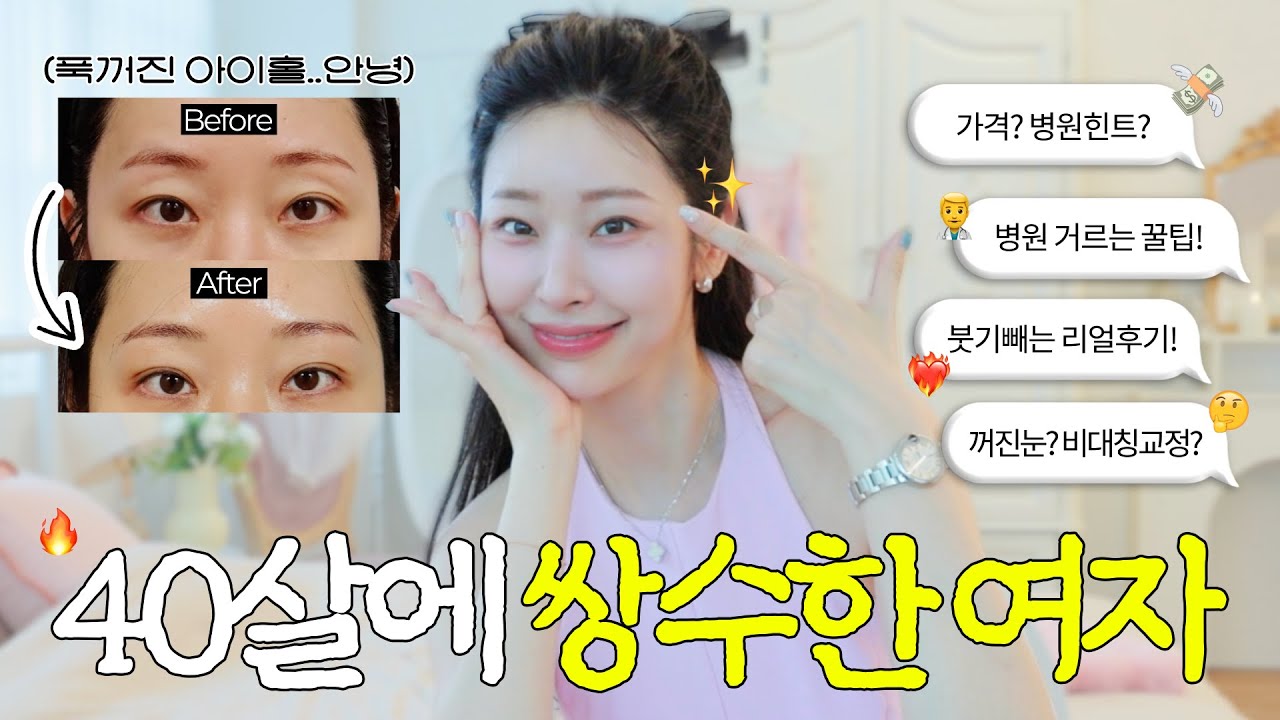 쌍밍아웃👀🔥 2025 요즘 쌍수의 모든것.zip (✔️병원정보, 쌍수가격, 매몰or절개?? 지방이식, 쌍수붓기과정, 붓기집착광공템 등등)