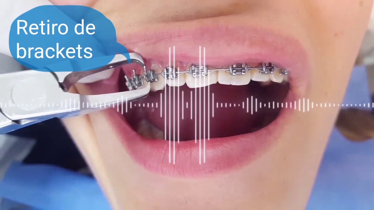 Consentimiento Informado De Retiro De Brackets