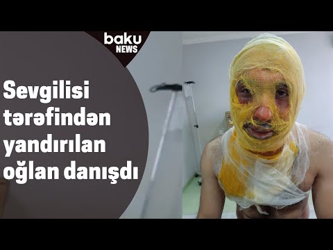 Sevgilisi tərəfindən yandırılan oğlan danışdı - Baku TV