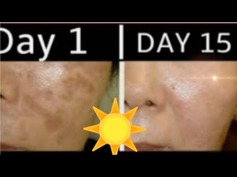 Vidéo: Comment savoir si vous avez la peau endommagée par le soleil ?