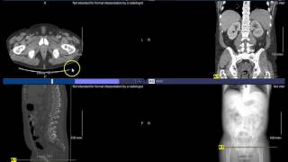 PACS - CT Male Pelvis