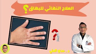 علاج البهاق ( البرص )