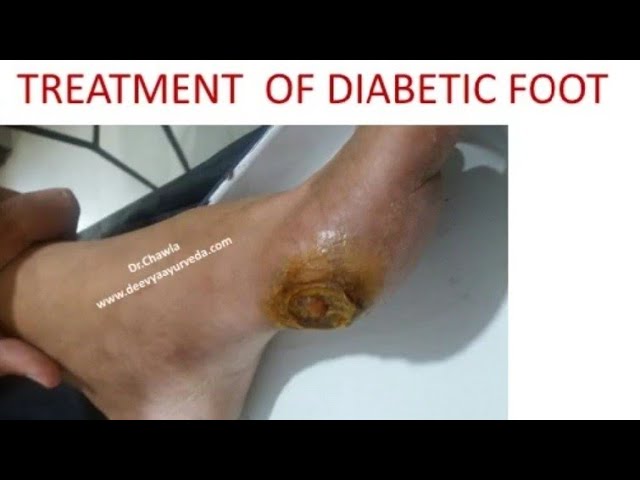 Diabetic Foot Treatment with Ayurveda