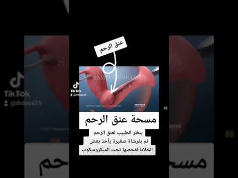 شاهدي كيف نقوم بعمل مسحة عنق الرحم