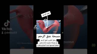 شاهدي كيف نقوم بعمل مسحة عنق الرحم