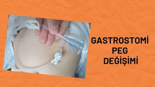 Efehan'ın Gastrostomi tüpü (peg) değişimini nasıl yapıyorum?